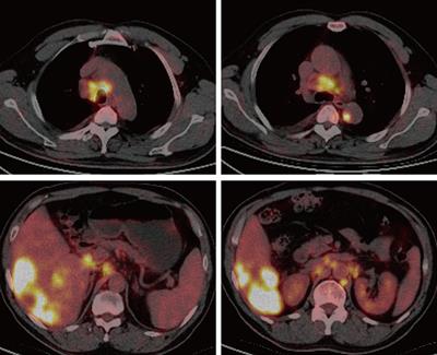 Advanced HCC with amplified mesenchymal epithelial transition factor receptor responds well to savolitinib: a case report